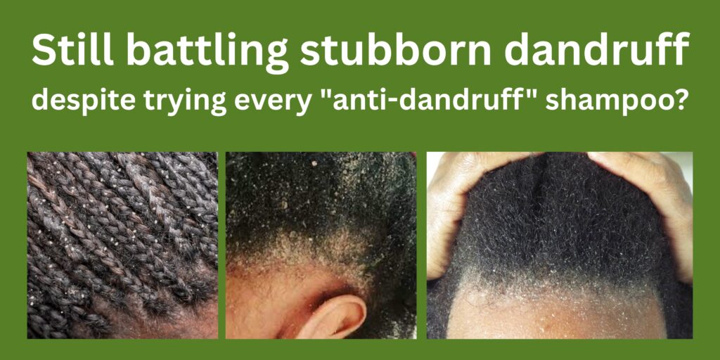 stubborn dandruff